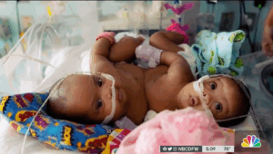 These Conjoined Twins Finally Went Home after an 11-Hour Surgery